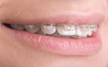 تقويم الأسنان.. أنواعه ومدة العلاج